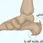 خار پاشنه
